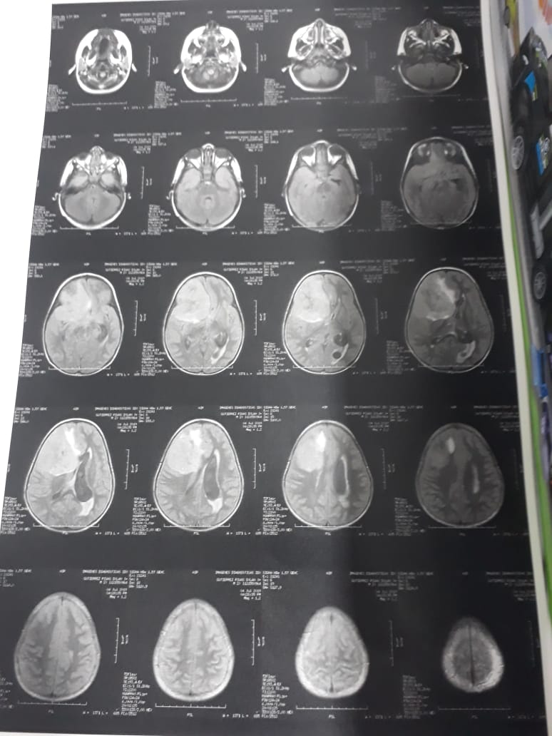 Jhableidy2's tweet photo. @fdbedout necesitamos denunciar a coomeva por no autorización de una microcirugía para la extracción de un tumor cerebral a un menor de 2 años que se encuentra hospitalizado desde el 29 de junio y es una emergencia por el gran tamaño del tumor.  Contactarme al 3126405206 https://t.co/HoMhMAulrX