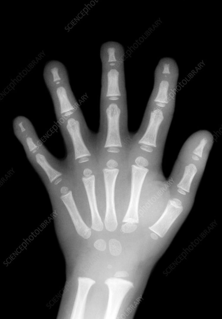 SwailesRuth's tweet image. An x ray of a developed hand (around the age of 7) compared to an EYFS age child’s hand is pretty informative. Also occupational therapists issue fantastic advice on how to develop handwriting in an age appropriate way matched to children’s physical development.