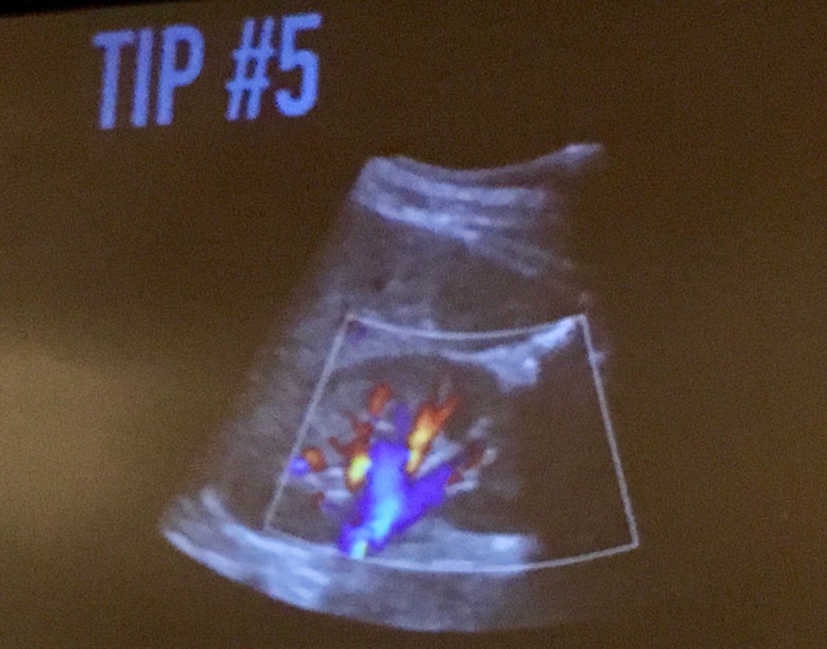 Jennifer Cotton (@sonomojo) on Twitter photo <a href="/UltrasoundJelly/">Ben C. Smith</a> Pro tip: prominent renal hilum looks like mild hydro. Use color flow to distinguish. Hydro = no flow. <a href="/UltrasoundJelly/">Ben C. Smith</a> Pro tip: prominent renal hilum looks like mild hydro. Use color flow to distinguish. Hydro = no flow.