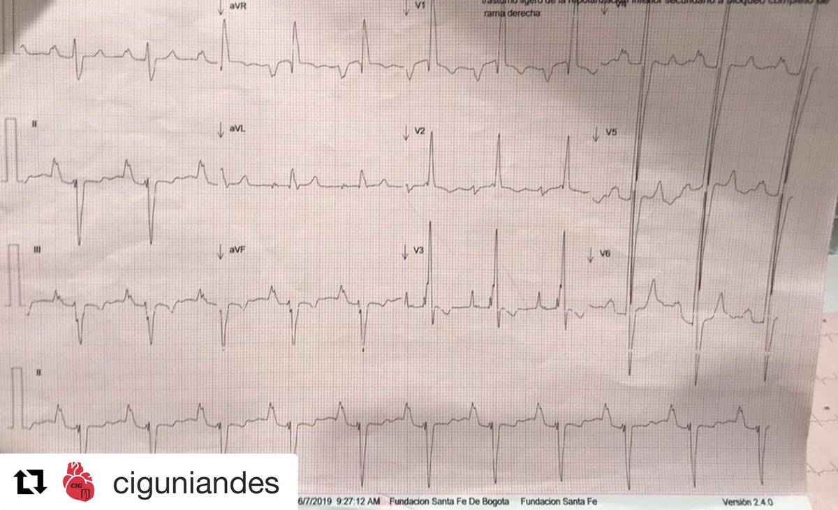 colegioelectro1's tweet photo. NUEVO DESAFÍO ELECTROCARDIOGRAFICO 👀😱 Paciente quien consulta por síncope, quien ha venido presentando palpitaciones ocasionales. ¿Diagnóstico? 
#heart #hearthealth #cardiology  #lovecardio #heartdisease #medicallife #medicine #salud #corazon #cardiologia #medico #ecg #ekg https://t.co/etyvXGtRQf