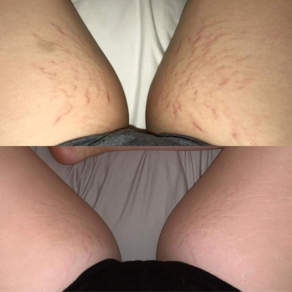 ShawnaBranchco2's tweet photo. Proper nutrition is so extremely important. One simple change to create NOTICEABLE results 🔥 🔥

👋 👋 bye bye stretch marks 👊👌 https://t.co/X5JLtUmZpJ