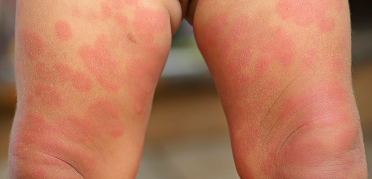 DermTimesNow's tweet image. During their lifetimes, as many as 63% of adults with psoriasis have psoriatic lesions on their genitals, but nearly 50% of those with genital psoriatic lesions don’t talk about symptoms with their doctors, suggesting #genital #psoriasis is undertreated: buff.ly/2LSLmdk