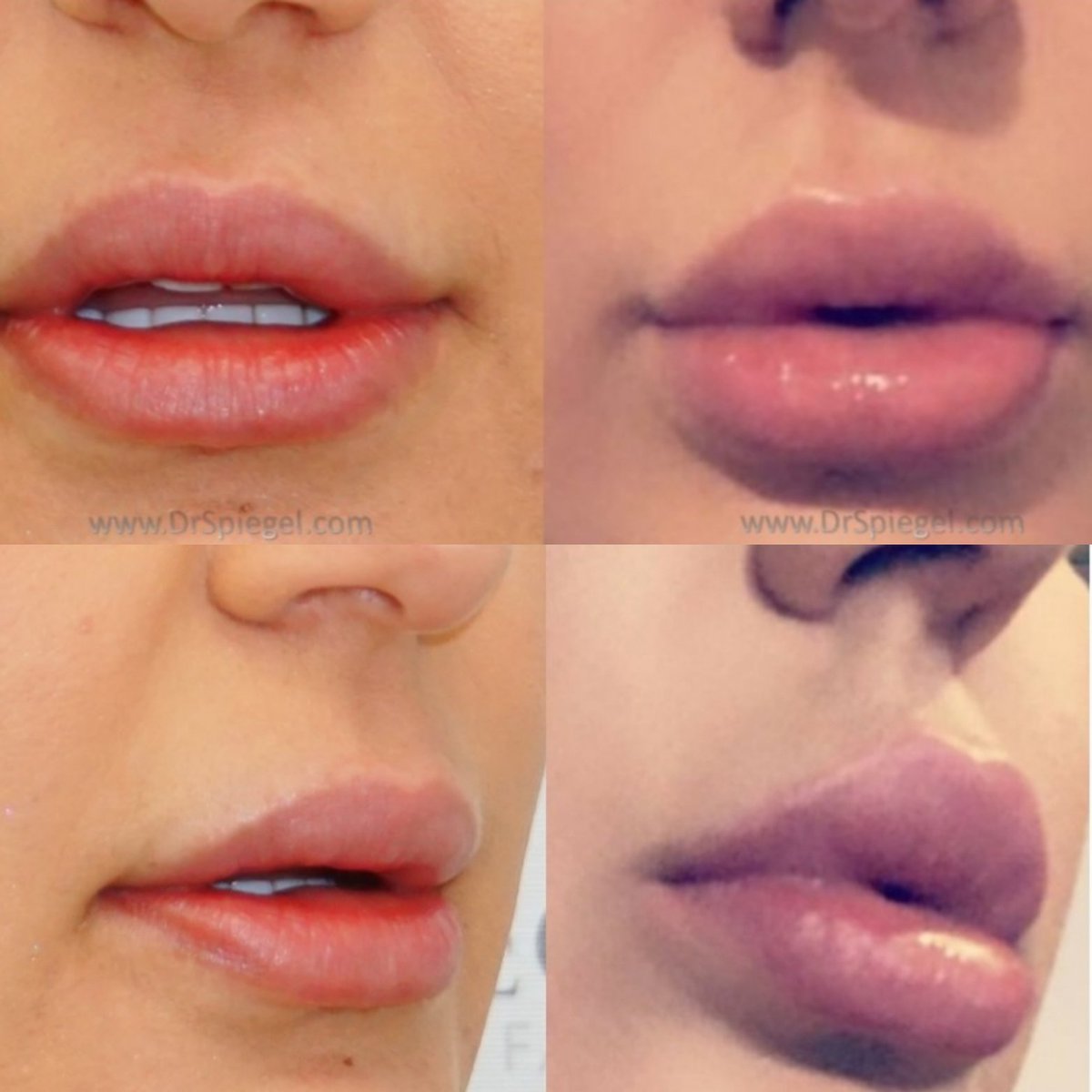 DrSpiegel's tweet photo. What's a bigger complement than sharing your fab results?
#sharingiscaring
#bestinjectorinboston #bestlips #bestlipfillers #lipfillers
Which #filler is this? #versalips #restylanelips #juvedermlips
https://t.co/hlY2cCaK8m https://t.co/v7R1hFxlbW