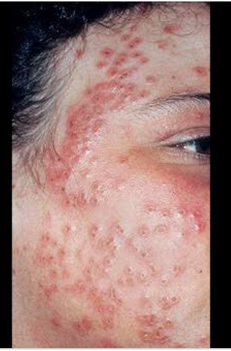 Doctorsarah3's tweet photo. Eczema cure herbal products are now available call us on +27799196969
Email.docsarah2018@gmail.com
#eczema_cure_product https://t.co/tcLhNfm19d