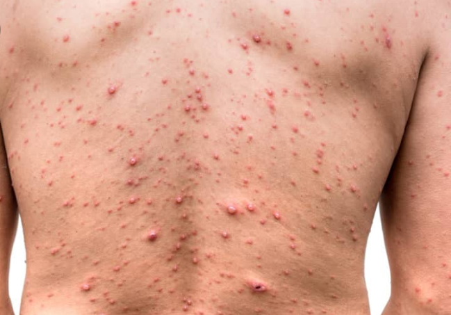 Doctorsarah3's tweet photo. Eczema cure herbal products are now available call us on +27799196969
Email.docsarah2018@gmail.com
#eczema_cure_product https://t.co/ACBpC9nQgZ