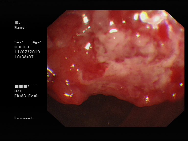 UKGastroDr's tweet photo. On first look I thought it was innocuous, a benign looking polyp.

However on a complete inspection, there was a more disrupted &amp; firmer looking lesion which looks like a CRC.

I have biopsied &amp; sent for CT. I will update these reports on Tuesday. 

#BonusCase #PolypThursday https://t.co/COizEu8CLc