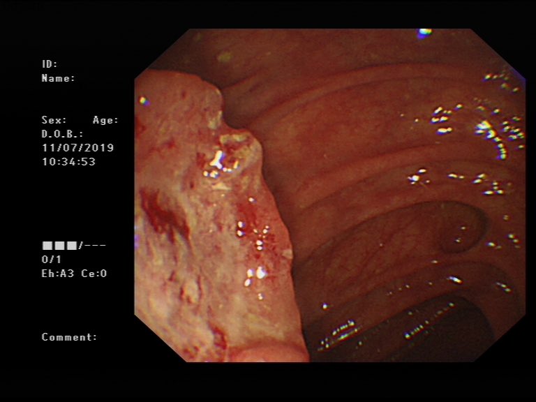 UKGastroDr's tweet photo. On first look I thought it was innocuous, a benign looking polyp.

However on a complete inspection, there was a more disrupted &amp; firmer looking lesion which looks like a CRC.

I have biopsied &amp; sent for CT. I will update these reports on Tuesday. 

#BonusCase #PolypThursday https://t.co/COizEu8CLc