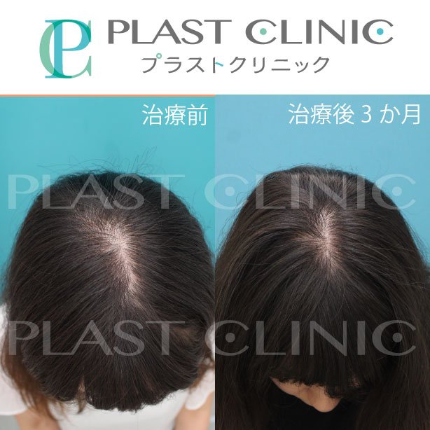 女性の薄毛治療