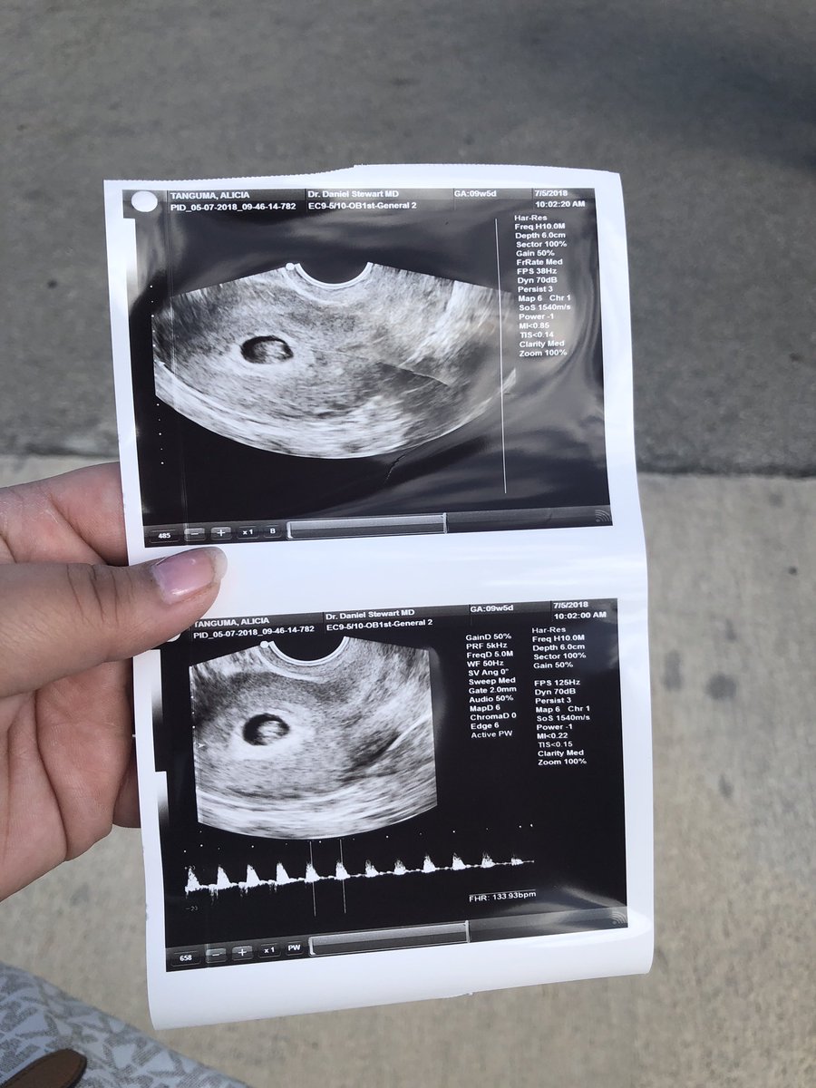 amtbeautyxo's tweet photo. I dreaded this day all week.... last year on this day was the worst day of my life. I may have never met you, but I promise I love you. Iโd give anything to just hold you. #RIPBABYJ They say it gets easier....but damn man, this shit hurts like hell. https://t.co/knZn84yNWP