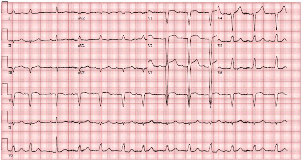 ACCinTouch's tweet photo. Test your knowledge w/ the #ECG of the Month on a 75-year-old man w/ acute increase in dyspnea &amp; chronic cough. What does his ECG show? https://t.co/1DJu3JFKJd #ACCEd #EKG https://t.co/reBfaJsIUt