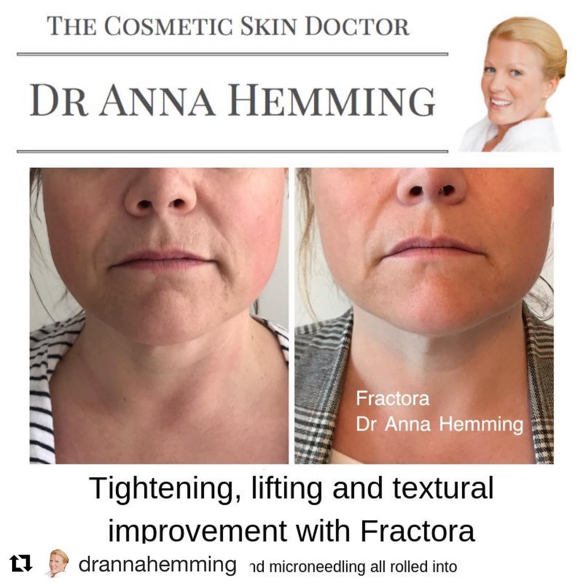InmodeUK's tweet image. Radiofrequency combined with #microneedling achieves skin resurfacing, textural improvement, treatment for fine lines, laxity and fragility as well as #acne #scarring and rough textured skin. #Fractora 
#Repost @DrAnnaHemming with @get_repost @thamesskinclinic