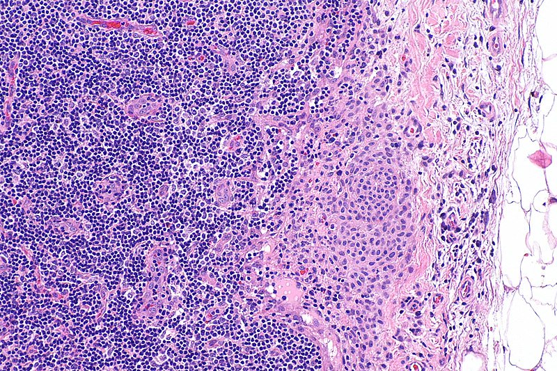 librepathology's tweet photo. Nodal nevus: can be diagnostic dilemma and can be confused with #melanoma - #pathology #dermpath https://t.co/LHAjn8bET8 https://t.co/oI3HOGUO9w