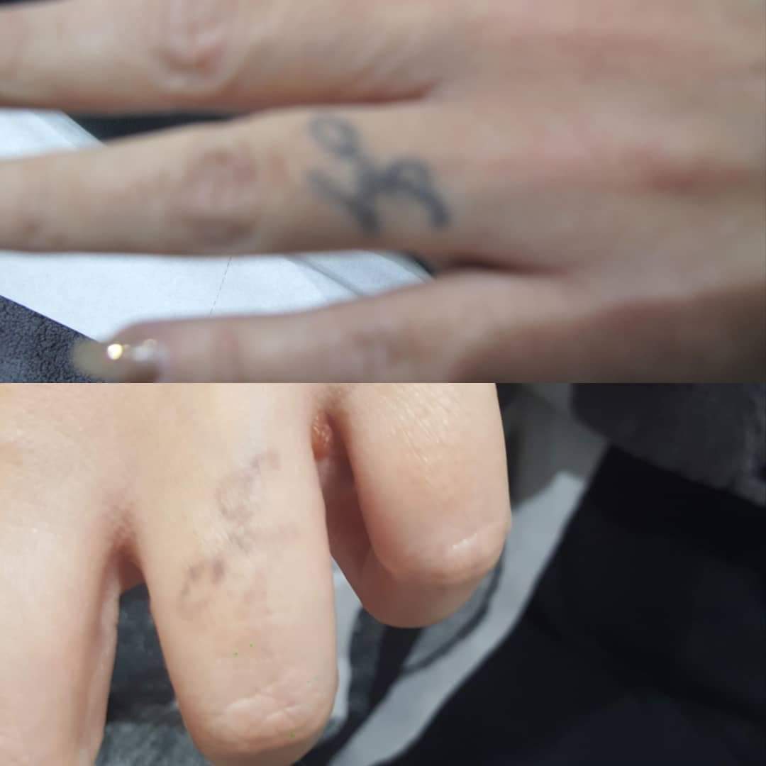 NuSkinLaser1's tweet photo. Tattoo removal after 3 sessions! https://t.co/Mwqlr8rj7F
#tattooremoval #Studio #Chelmsford #changes #ink #AW3 #Laser https://t.co/lYZ84SdYkH