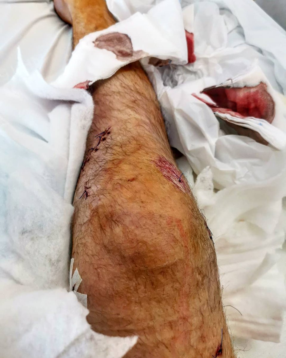 After 3 hrs of surgery I'm thrilled to announce that everything went well. This morning I started with physical therapy. I'll be back even stronger. See you soon in the cage/rage/ring 😎💣
#mmaspirit #t800 #illbeback