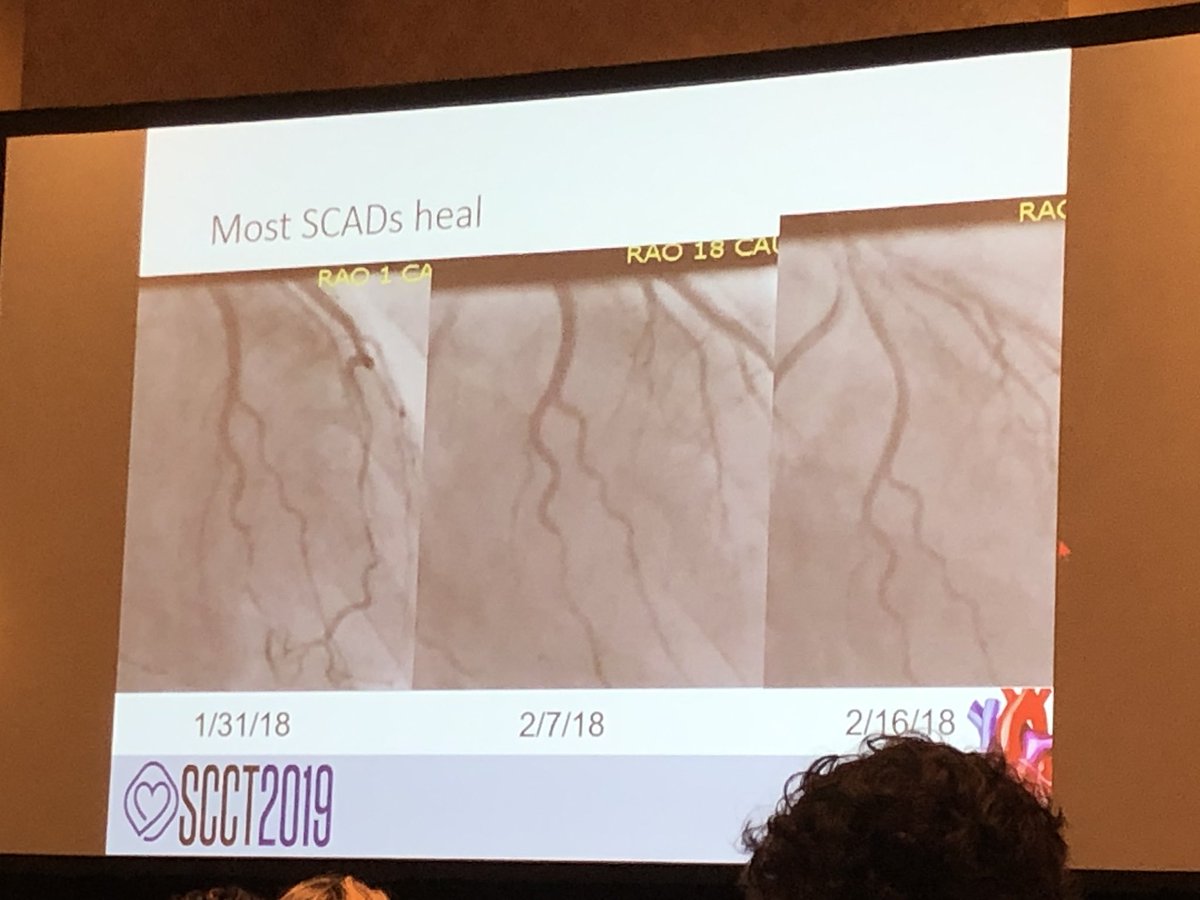 Brian with the Good Dictations (@ghoshhajra) on Twitter photo We don’t advocate followup imaging of SCADs unless recurrent symptoms but much to be learned from historical cases, like these conservatively managed patients whom healed. #SCAD expert <a href="/drmalissawood/">Malissa Wood</a> at #SCCT2019 (PS thanks for the shoutout!) We don’t advocate followup imaging of SCADs unless recurrent symptoms but much to be learned from historical cases, like these conservatively managed patients whom healed. #SCAD expert <a href="/drmalissawood/">Malissa Wood</a> at #SCCT2019 (PS thanks for the shoutout!)