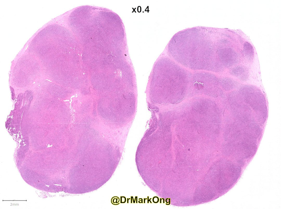 Specimen from adolescent male. What's your #LPpath diagnosis? #pathology