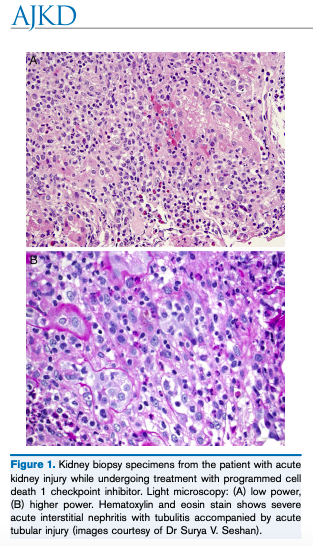 AJKDonline's tweet photo. Kidney Complications of Immune Checkpoint Inhibitors: A Review by Roman Shingarev and Ilya G. Glezerman https://t.co/NkB6CHd2hr https://t.co/anAoE9UCAA