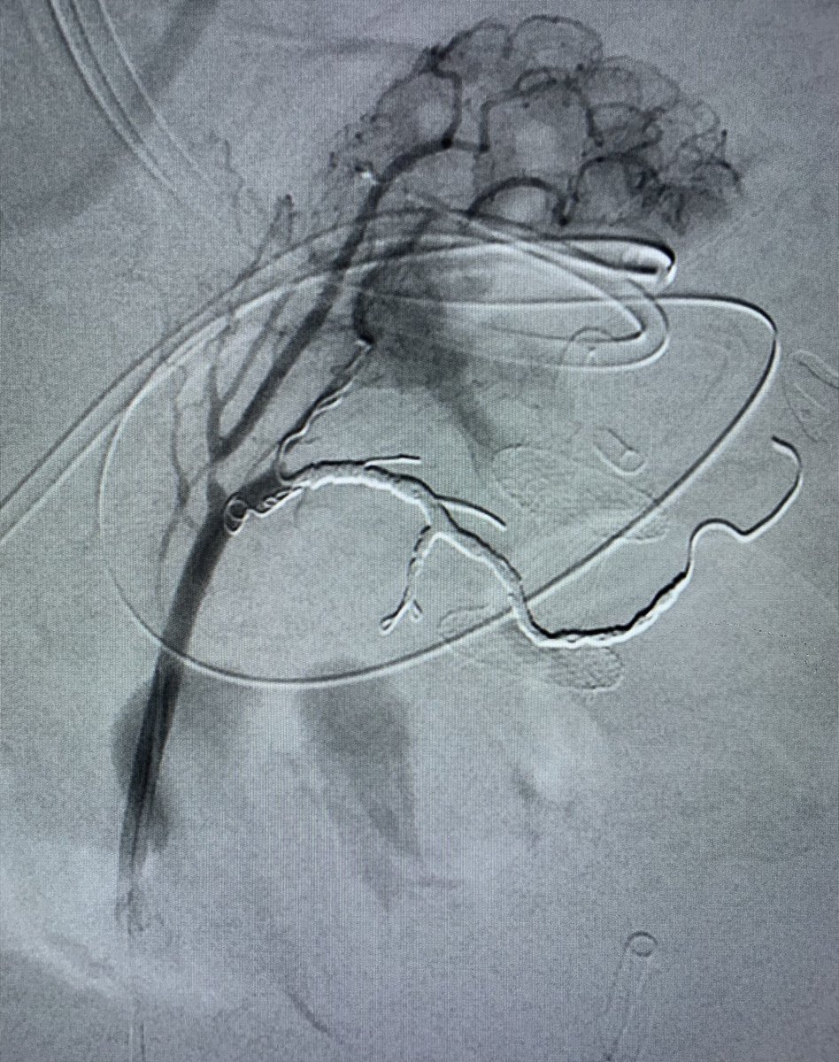 kavaliIR's tweet photo. Decent iatrogenic left gastric artery bleeding secondary to cyst gastrostomy tube placement. #IRad to the rescue! Good case to start #CallWeekend @WashUIR! @SIRRFS @SIRspecialists @maninbsir @ChrisDMaloneVIR @rramaswamy https://t.co/c6vD34Mdww
