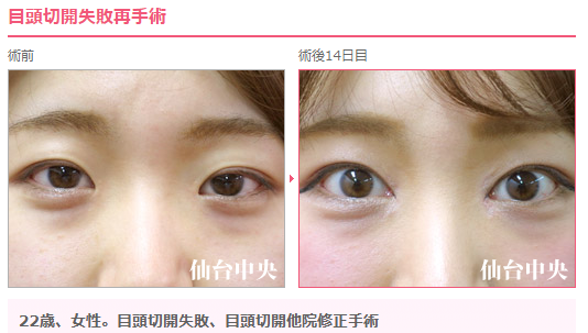 仙台中央クリニック美容整形美容外科 Twitter પર 目頭切開失敗 により 戻った 傷だけ残った 左右差があるという 目頭切開再手術 が増えています 目頭切開 は 設定を適切に行わないと変化が分かり難いリスクを認めることがあります 幅広ライン 二重仙台