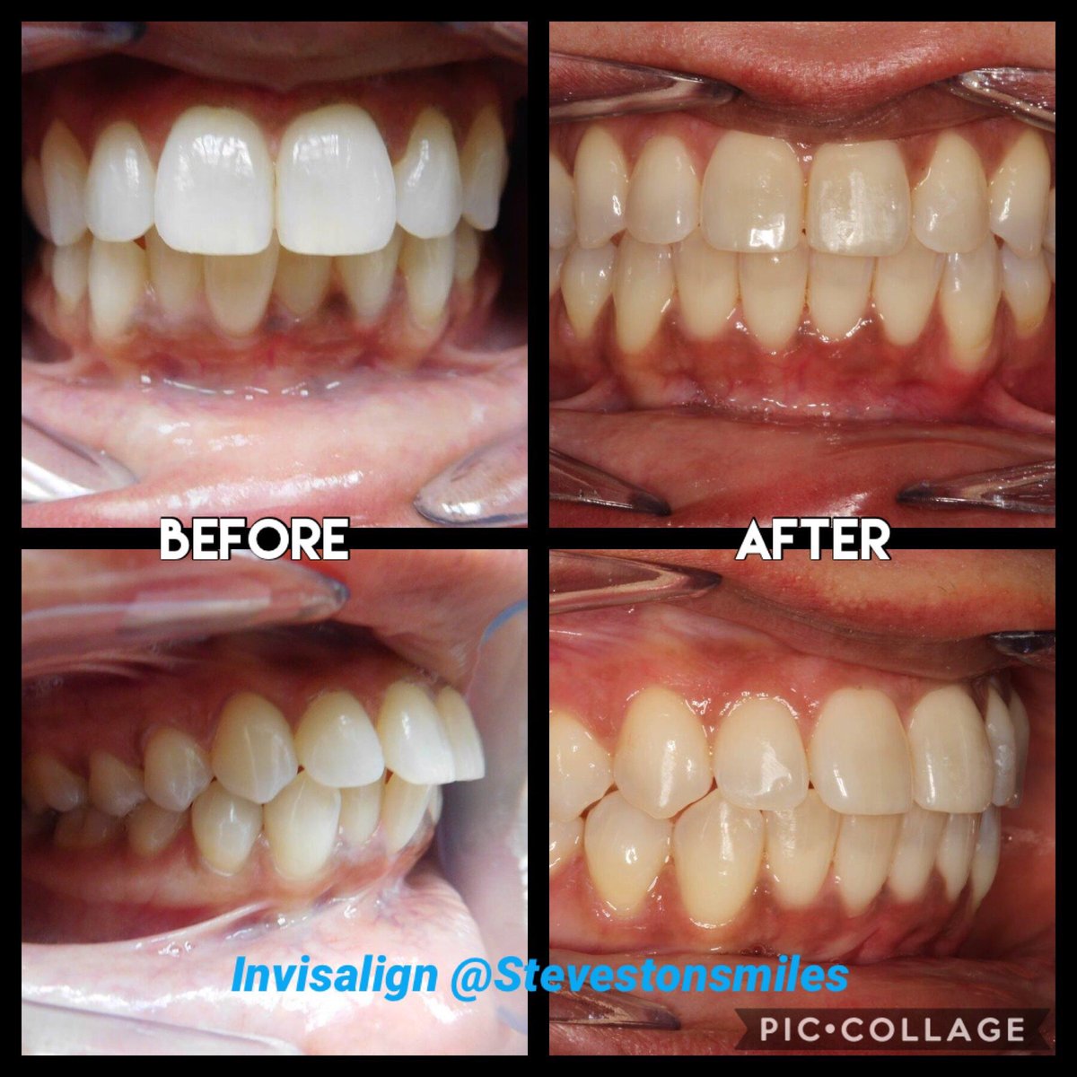 Invisalign Before And After Crowding