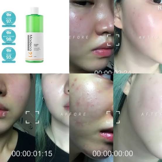 thecosmeticskr's tweet photo. #พร้อมส่ง 🍀🎉 #Madeca21 Tecasol Toner
🌺โทนเนอร์บำรุงผิวสูตรผสมใบบัวบกและ cica เข้มข้น 89% ช่วยลดอาการอักเสบ รอยแดง รอยดำจากสิว เพิ่มความชุ่มชื้น ยอดขายอันดับ 1 ในร้าน lalavla
🍀ขนาดใหญ่500ml
✨ราคา 1190.-
#สกินแคร์เกาหลี #คสอเกาหลี #สกินแคร์รักษาสิว #ของดีเกาหลี https://t.co/0ZjbOKB4oH