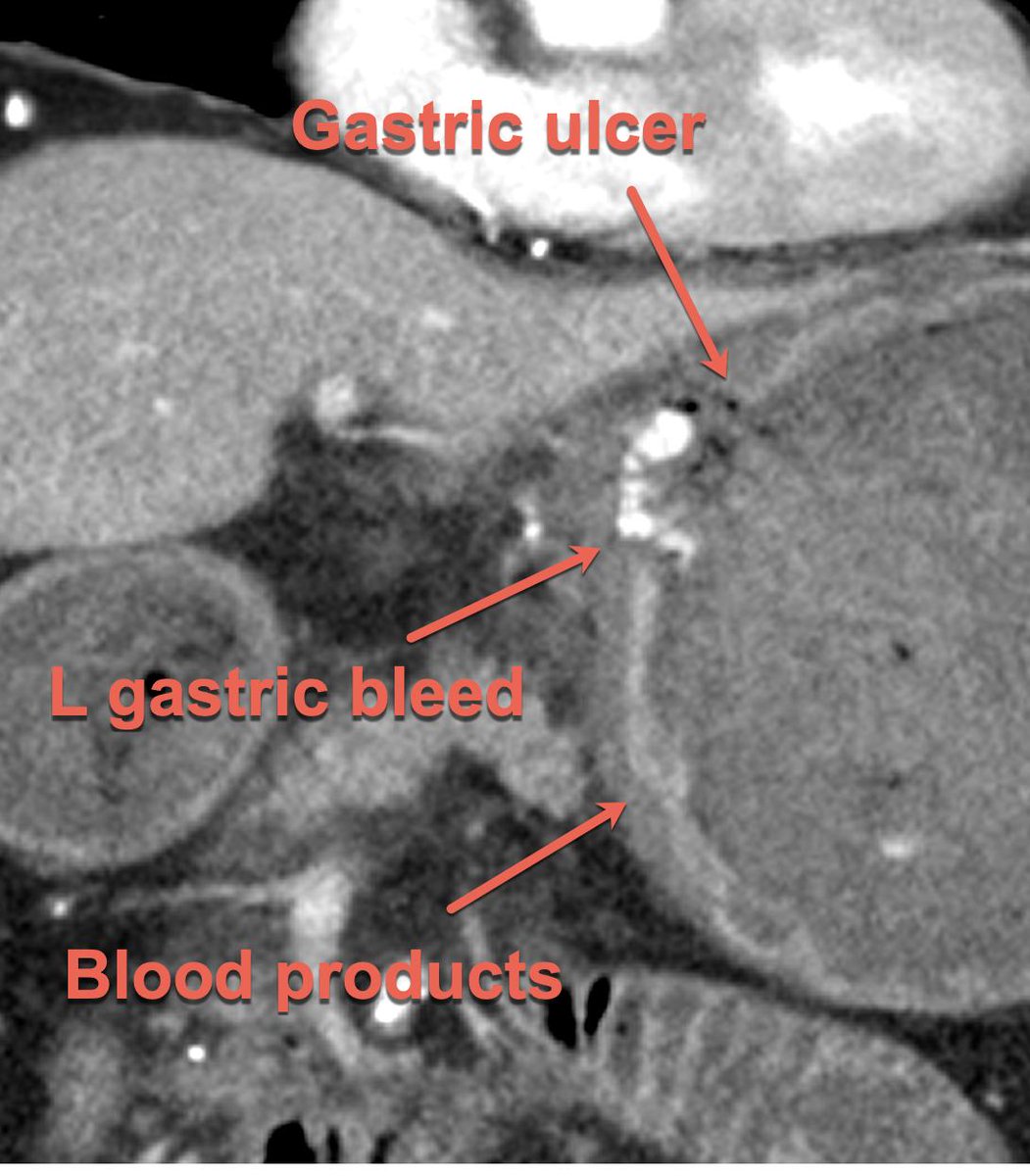 djabdo_md's tweet photo. @kavaliIR @WashUIR @SIRRFS @SIRspecialists @maninbsir @ChrisDMaloneVIR @rramaswamy Saw your embo right before I started my own #callweekend and I got one of my own! Massive L gastric #bleed/psa in a vasculopath w/an aortic endograft stopped w/@medtronic Concerto coils and some gelfoam @HoustonRadAssoc. Nice little anatomic variant for @SIRRFS. https://t.co/ccx8N4vfed