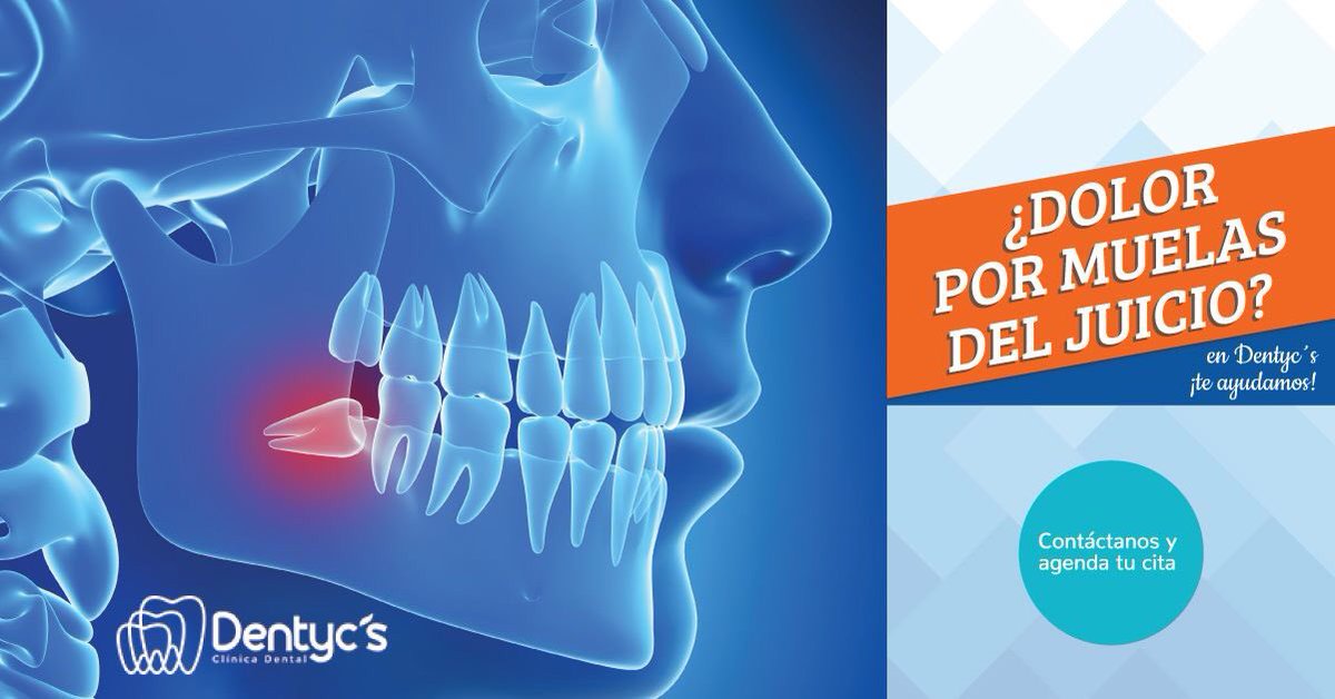 DentycsSc's tweet image. ¿Dolor e incomodidad? 😣
Una muela que se encuentra en mala posición puede modificar o perjudicar la posición de los demás dientes, además de causar caries o incluso pulpitis.¡En #Dentycs podemos  ayudarte agenda tu cita ahora! ✨.Contáctanos y agenda ahora 
#dentistadelvalle