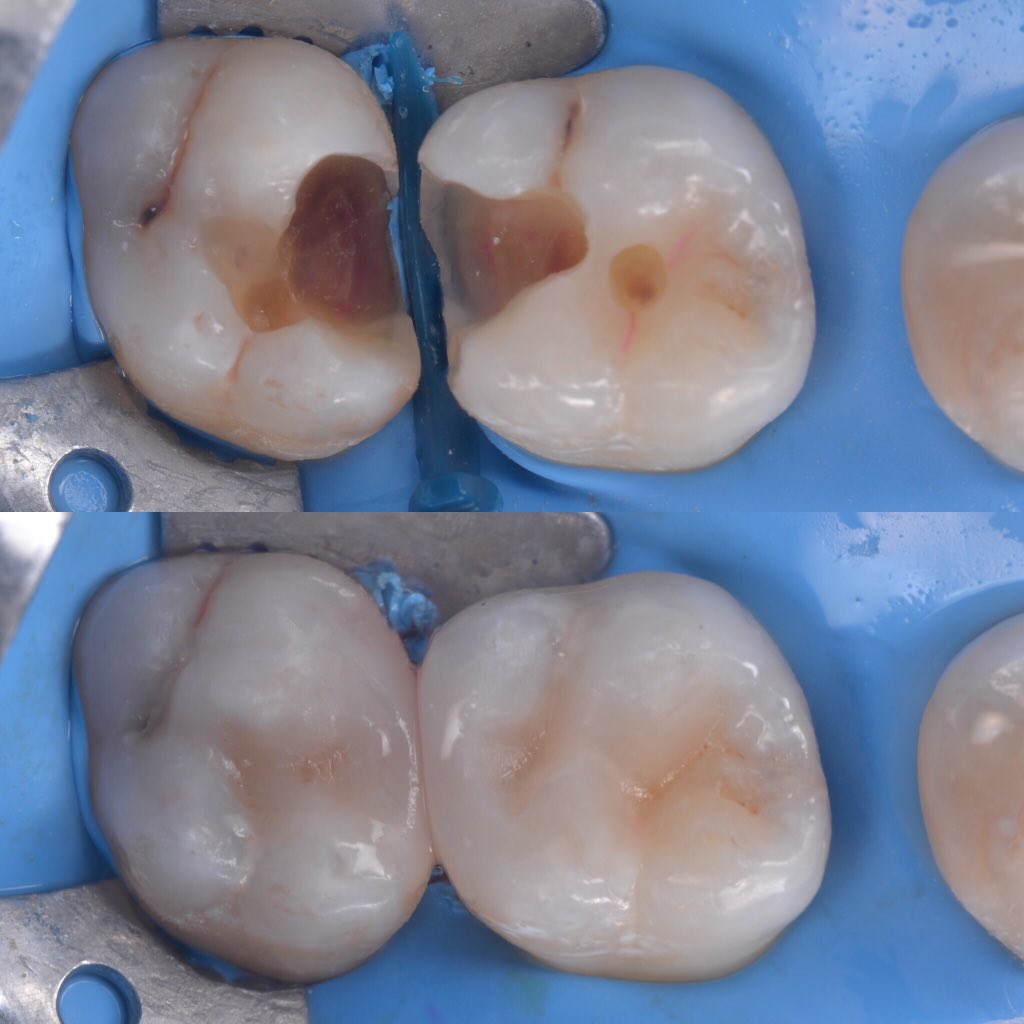 hakancolakdds's tweet image. Direct posterior #directcomposite #restorativedentistry