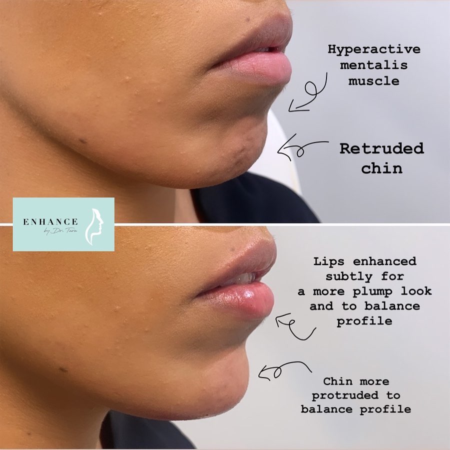 Non-surgical lip and chin enhancement is a subtle way to feminise the face and create profile balance harmony. This can be safely &amp; naturally achieved by Dermal Fillers which restore volume and fullness to refresh and revitalise your look. Learn more here: qoo.ly/ypfcy