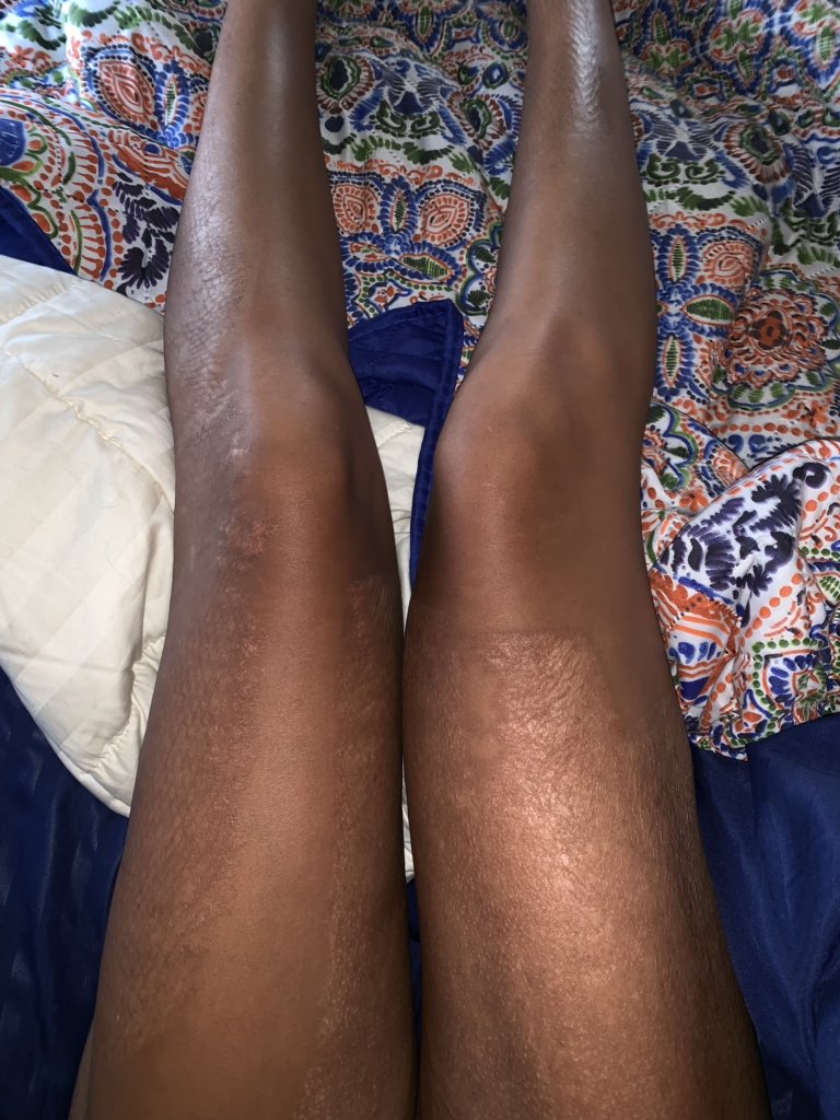 KeAsiaStormm's tweet photo. Today is huge for me. One year ago today, I was in a boating accident. I received 3rd degree burns. Here are pictures in order of me healing. I’m now fully healed and waiting for the scars to fade. Words can’t describe how blessed I am. https://t.co/TyB0K7eCEE