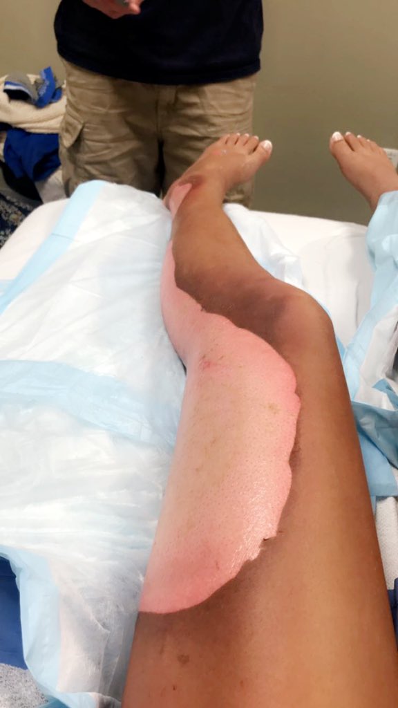 KeAsiaStormm's tweet photo. Today is huge for me. One year ago today, I was in a boating accident. I received 3rd degree burns. Here are pictures in order of me healing. I’m now fully healed and waiting for the scars to fade. Words can’t describe how blessed I am. https://t.co/TyB0K7eCEE