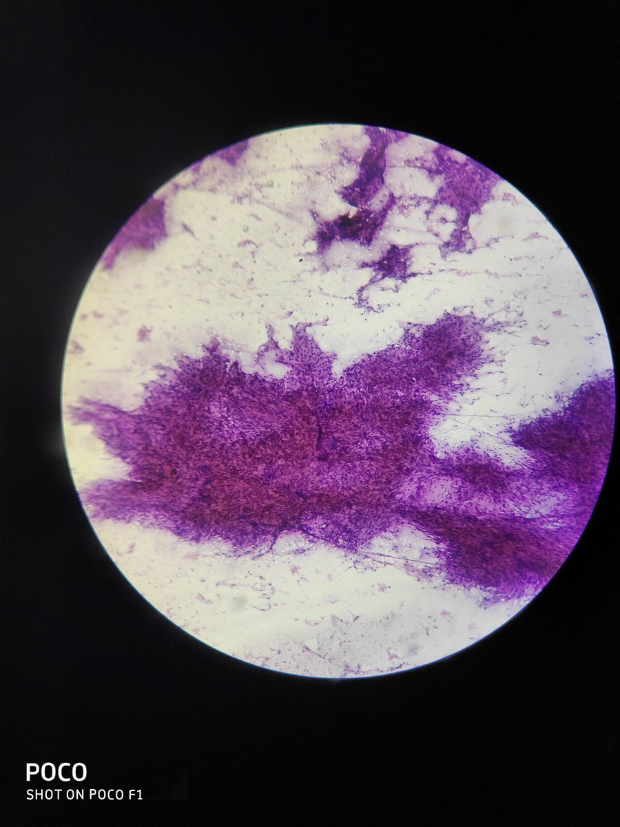 BhuvaneshwariA8's tweet photo. 51 year female lower abdominal swelling measuring 5×5 cm ...Usg likely desmoid tumor..what is the likely diagnosis? https://t.co/7fqx42QRvS