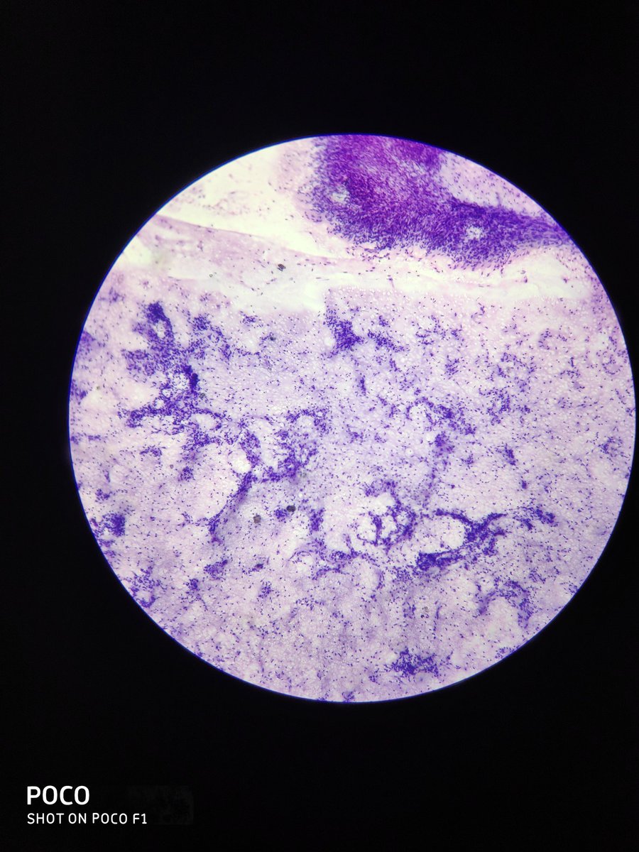 BhuvaneshwariA8's tweet photo. 51 year female lower abdominal swelling measuring 5×5 cm ...Usg likely desmoid tumor..what is the likely diagnosis? https://t.co/7fqx42QRvS