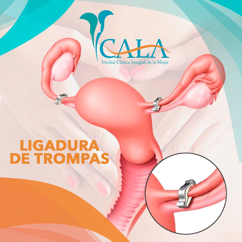 MujerCala's tweet photo. En Cala contamos con especialistas en cirugía mínimamente invasiva, lo que permite realizar este procedimiento de una manera más práctica y con menor dolor.🙌🏻

Contáctanos a través de nuestros números telefónicos para mayor información🤳🏻

#Cirugia #minimamenteinvasiva #ligadura https://t.co/zeGXY1Hecu