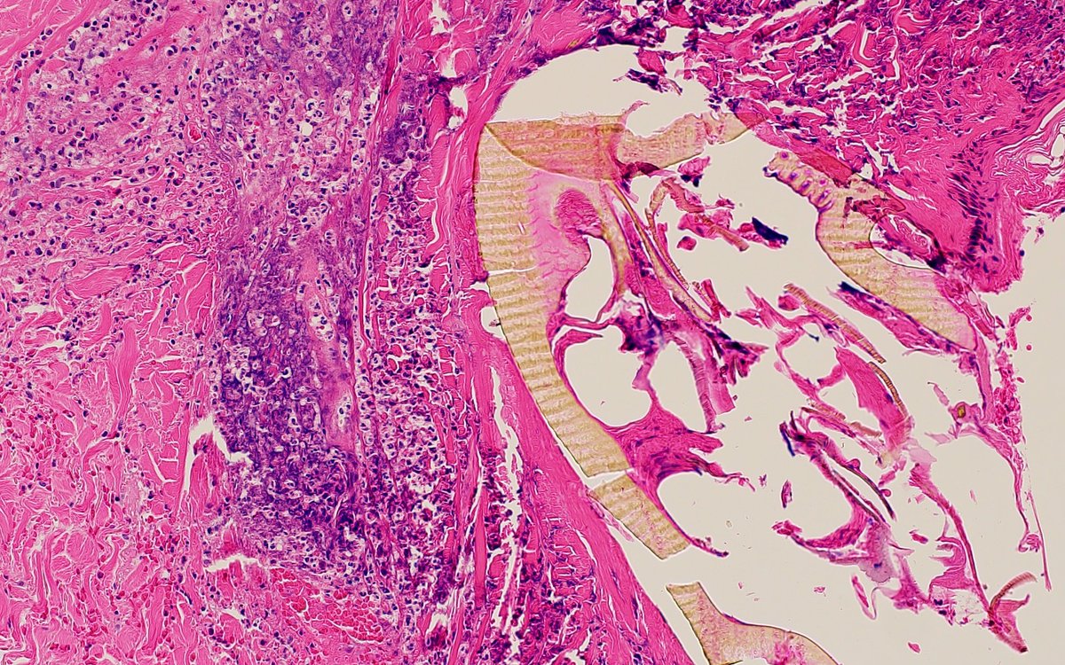 I thought this was a good section.  #tickbite #dermpath #pathology #idpath