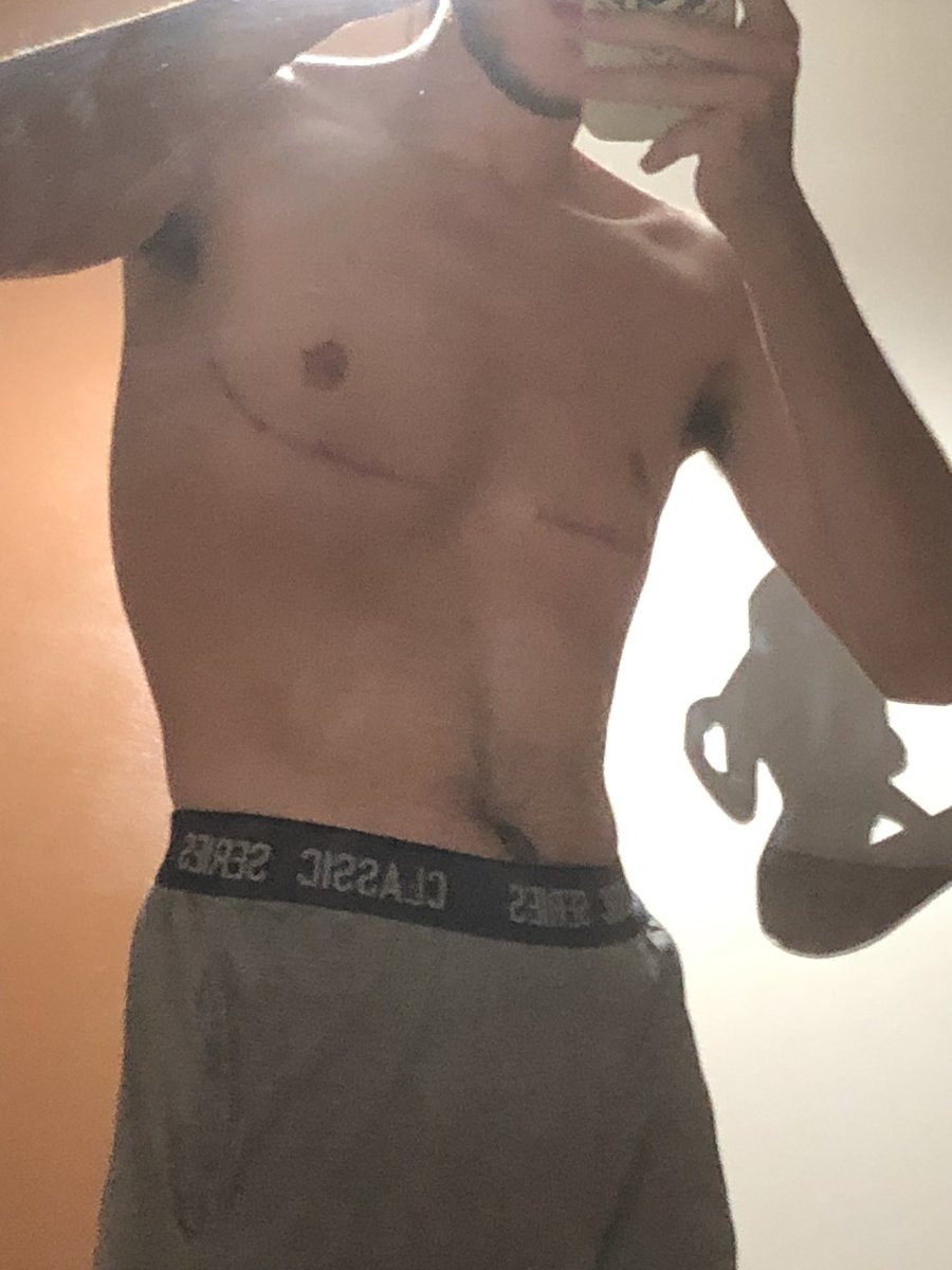 Hey, j’avais oublié de poster des photos pour les 3 mois. Du coup là je suis à presque 4 mois post-op, les cicatrices se sont étirées un peu depuis 2 mois post-op, mais rien d’énorme quoi. (Desolé pour les photos mauvais qualité, j’ai pas un bon éclairage du tout le soir)