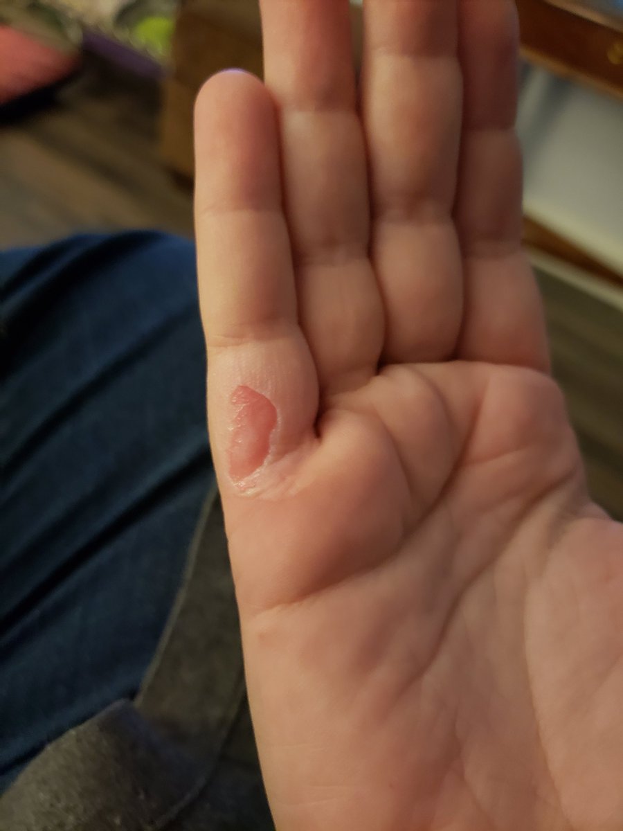missrenge's tweet photo. Thought I'd be smart and catch up on all the little odds and ends that needed doing for my cosplay. Got a good bit done and then burned the mess out of myself with hot glue. #ouch #hotglueburn #firstdegreeburn https://t.co/y5MHtWiOIE