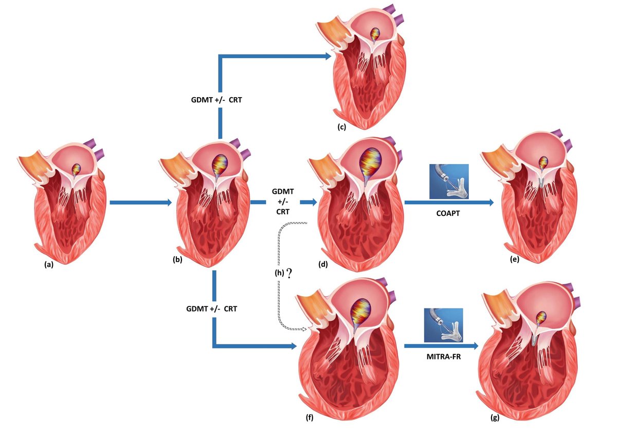 Cardiobro's tweet photo. Our uptotdate review on Percutaneous Mitral Valve Repair Strategies in degenerative and functional mitral regurgitation now published in Frontiers in Cardiovascular Medicine @JordeUlrich @MonteHeart : 
#Mitraclip #functionalMR #Percutaneousrepair #primaryMR #heartsuccess https://t.co/Jrk3901F6E