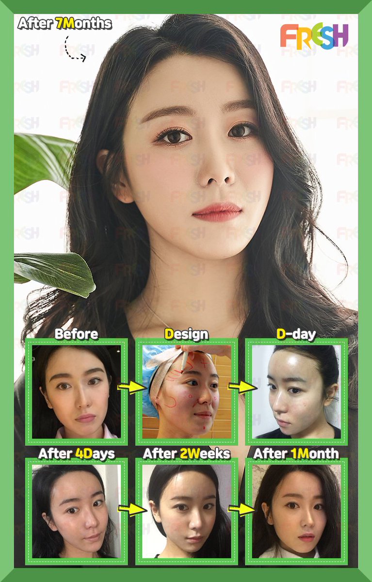 フレッシュ整形外科 در توییتر ダイアライン脂肪移植で 頬のこけや疲れて見えるお顔のイメージを改善 フレッシュ整形 韓国整形 美容垢 脂肪移植 童顔 小顔 脂肪整形 プチ整形