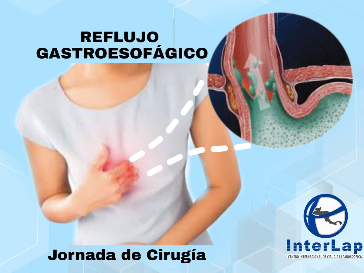 cirugia para reflujo gastroesofagico cirugia para reflujo gastroesofagico