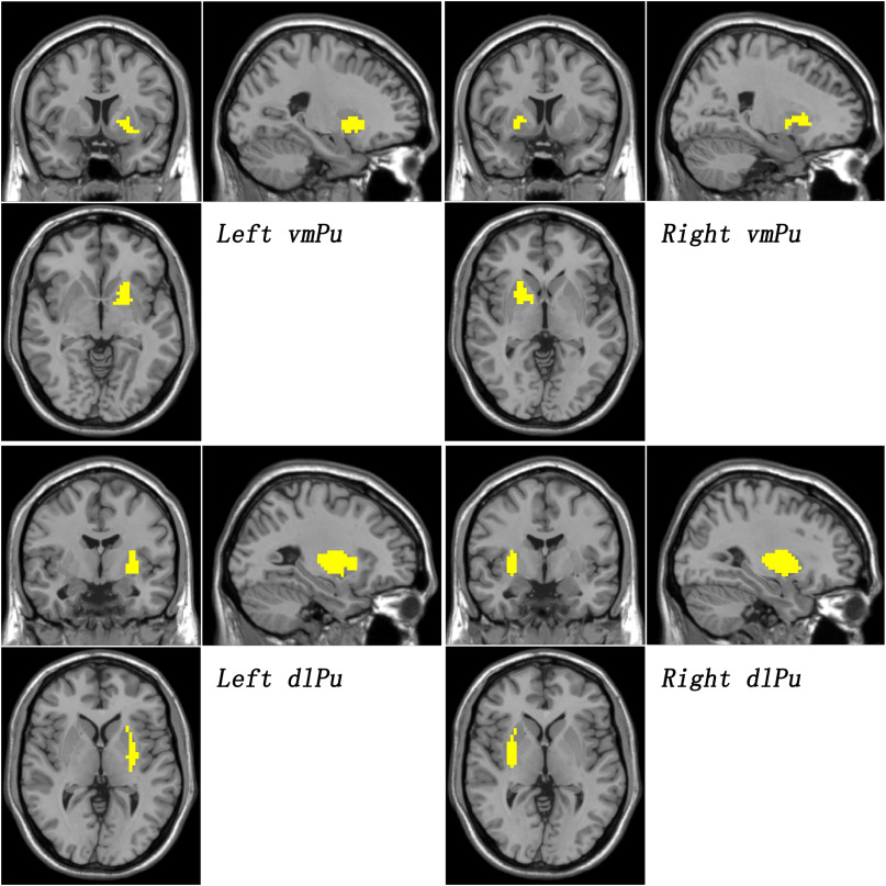 eBioMedicine's tweet photo. Read our new #openaccess study on #Schizophrenia: Jingping Zhao et al. show that
enhanced baseline activity in the left ventromedial #putamen predicts individual #treatmentresponse in drug-naive, first-episode schizophrenia https://t.co/fNy5R5LqGa '@EBioMedicine https://t.co/QSQdKy6fwk