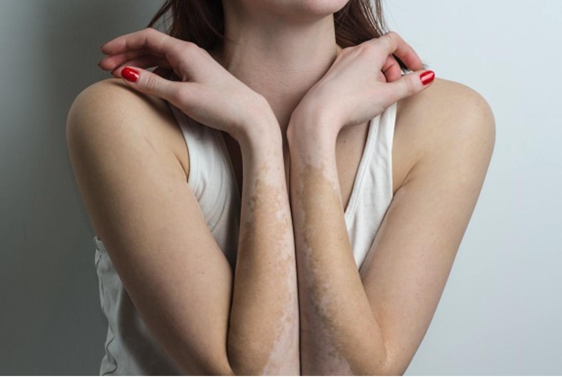 Le #Vitiligo, les traitements : 
sante-sur-le-net.com/journee-mondia…

#TraitementVitiligo #Dermatologue #Dermatologie #MedecineEsthetique #ProblèmedePeau