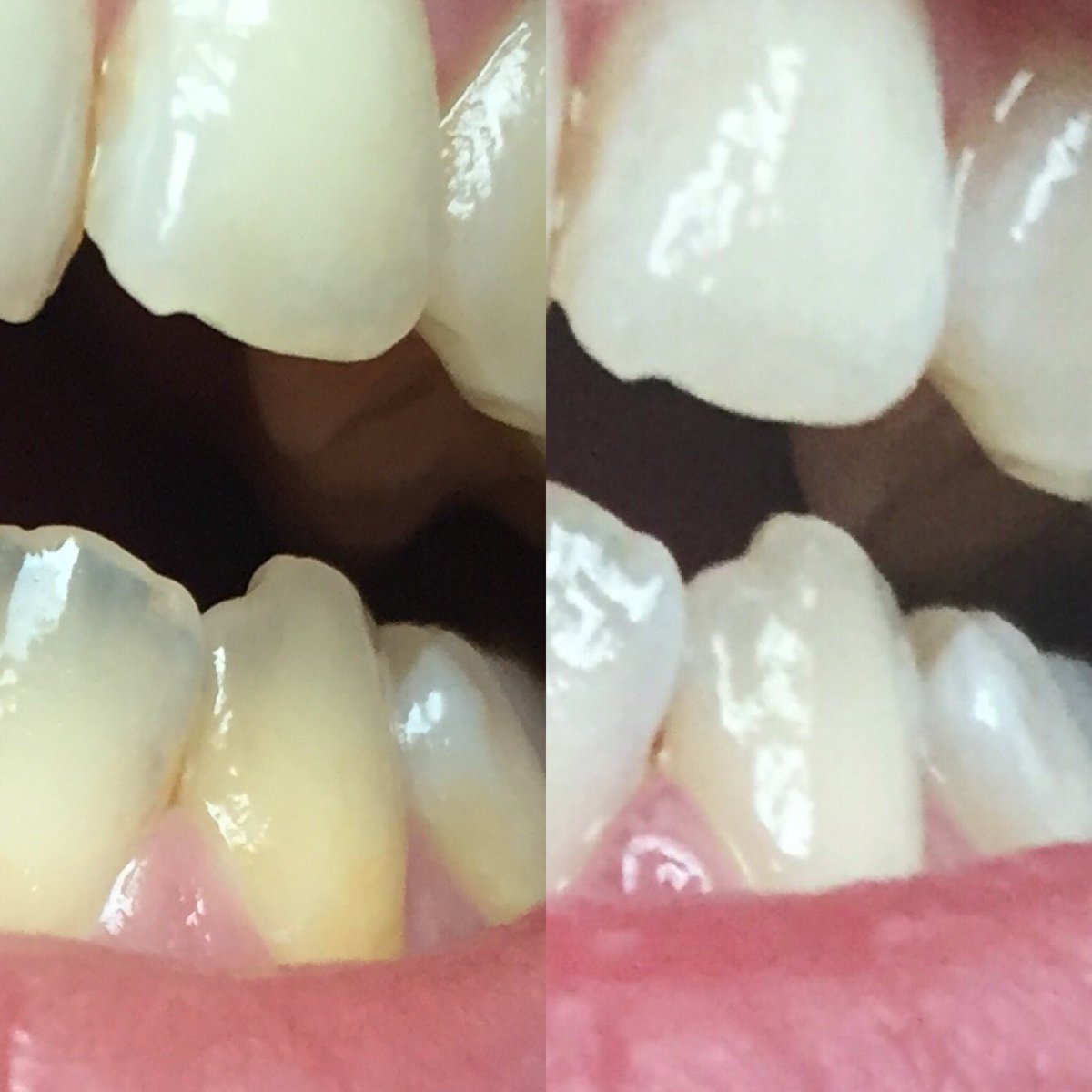 AleAleBe's tweet photo. Whitened my teeth!! Before and after🥟➡️🥛I have drunk coffee and for two decades now so this was needed. https://t.co/seFy4icy3Z