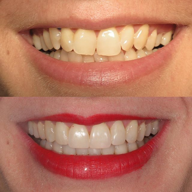 DentalChelsea's tweet photo. We love this case by @drrhonaeskander for more info call 02073498889 https://t.co/jMiyQpFdT1 https://t.co/QXsex6qF1C
