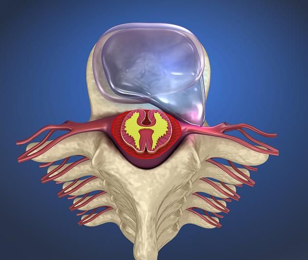 apex_spine's tweet image. Sie halten einige Hundert Kilogramm aus – unsere Bandscheiben. Denn die 23 Abstandshalter und Stoßdämpfer zwischen den Wirbelkörpern an unserem Rücken sind enorm belastbar. 
buff.ly/2jG2O9l