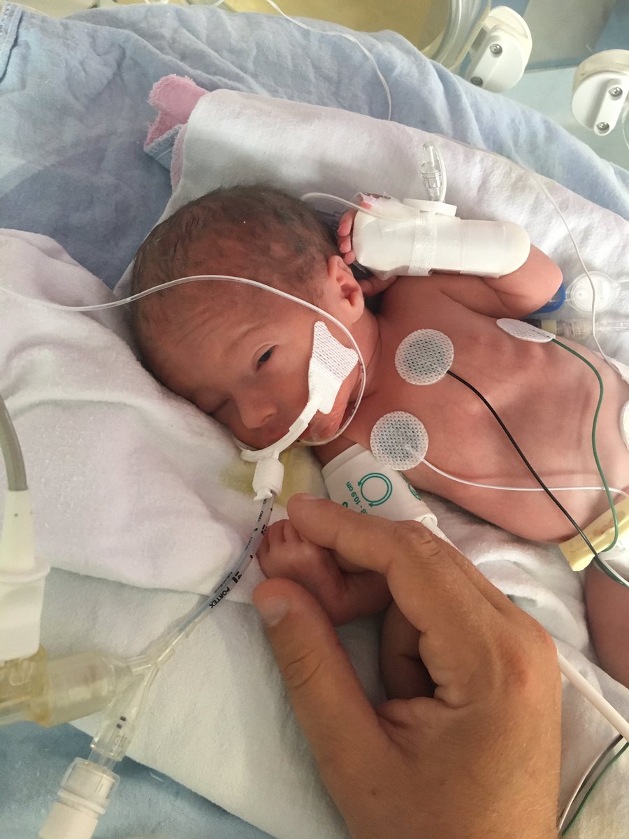 MangiaficoDavid's tweet photo. Mangiafico Triplets in the NICU Downtown Toronto https://t.co/oiDjg6Da3C
