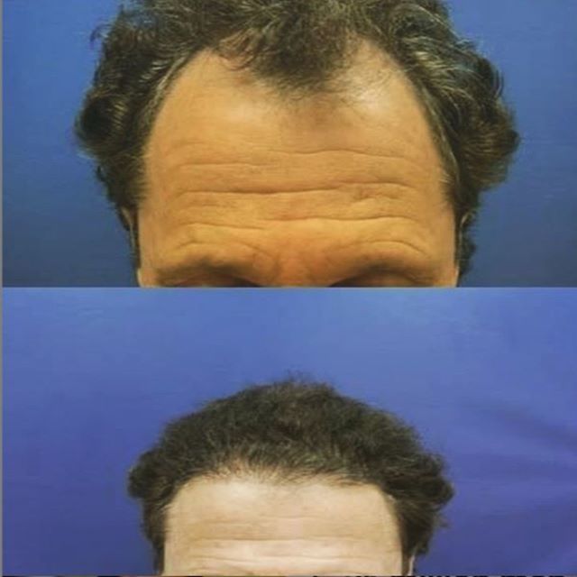 JLWilliamsMD's tweet photo. Before and after! 
This 53 year old male patient had one procedure with a total of 2034 grafts and he is ecstatic about the results! 
If you're interested in hair restoration visit our website or call us 888.357.0888
*
*
*
*
*
*
*
#hair #hairrestorastion #hairtransplant #mor… https://t.co/Aa8WMEMEjp