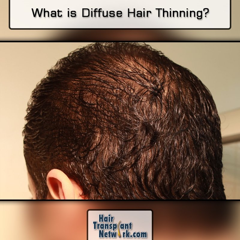 Hair Transplant Network on Twitter: Hair Transplant Network on Twitter: