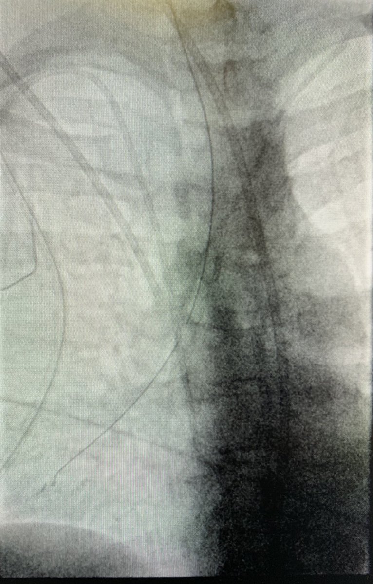 kavaliIR's tweet photo. Request for a left sided central venous catheter, which was placed appropriately, and this is the final image. Are we done here @SIRRFS? #lookateverything @WashUIR @maninbsir @ChrisDMaloneVIR https://t.co/eu26joOrQD