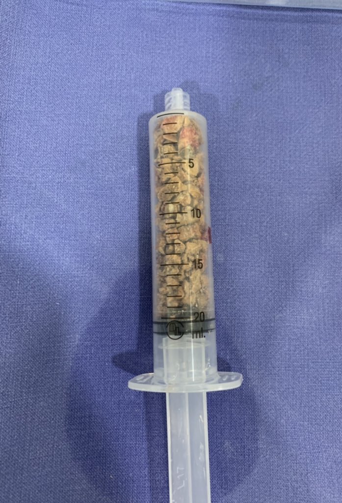 urovillicana's tweet photo. Was a fabulous surgery initiating #PCLN in #supine male of 56 years with coral stone of 1400 UH average time of total fluoroscopy 38 seconds #UroSoMe #endourology #YoPuncionoconEscovarLeon #UroSoMex #urology https://t.co/albl50fKcm